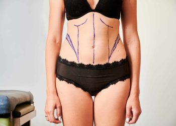female patient body with marks for plastic surgery.